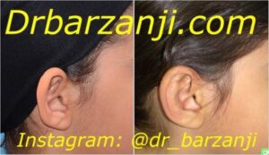 جراحی زیبایی لاله گوش برجسته