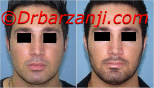 پروتز چانه یک هفته بعد از عمل