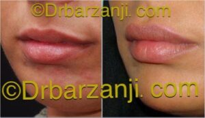 تزریق ژل جوویدرم (ژوویدرم )در لب ، 9 ماه بعد