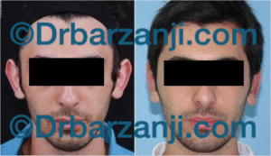 جراحی ترمیمی برجستگی لاله گوش