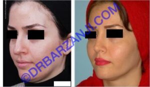 پروتز گونه و جراحی بینی