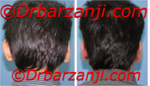 جراحی برجستگی گوش یک ماه بعد از عمل