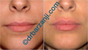 تزریق ژل لب (جوویدرم )