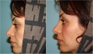 تزریق ژل در فرورفتگی پلک تحتانی- نیمرخ