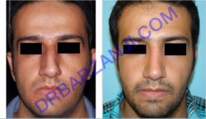 جراحی بینی، شش ماه بعد از عمل