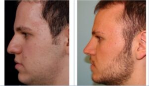 جراحی بینی، یک سال بعد