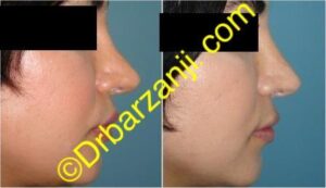 تزریق ژل رستیلن در بینی عمل شده