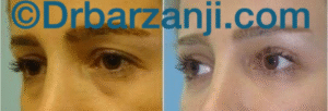 تزریق چربی زیر چشم و جراحی پلک بالا