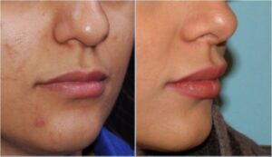 تزریق جوویدرم در لب ، یک سال و نیم بعد