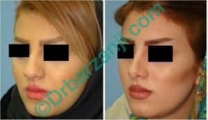 جراحی پلاستیک بینی شش ماه بعد از عمل