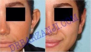 جراحی پلاستیک برجستگی لاله گوش چپ