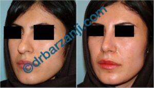 جراحی بینی یک ماه بعد از عمل