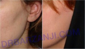 تزریق چربی در صورت