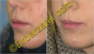 تزریق ژل لب