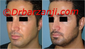 پروتز چانه یک هفته بعد از عمل