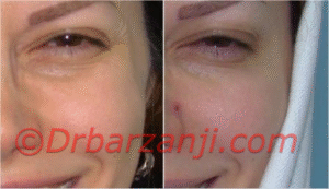 کاهش خطوط کنار چشم با تزریق بوتاکس ( دیسپورت )