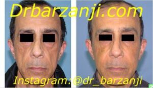 تزریق چربی صورت