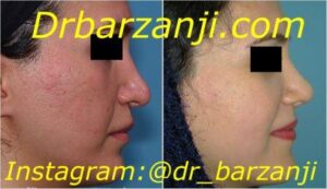 جراحی ترمیمی بینی چهار ماه بعد از عمل