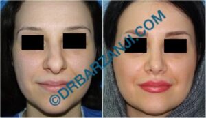 جراحی بینی یک سال بعد از عمل