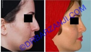 جراحی پلاستیک بینی، 4 سال بعد