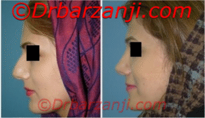 عکس قبل و بعد جراحی پلاستیک بینی شش ماه بعد