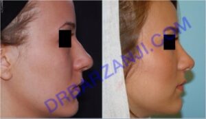 جراحی بینی، یک سال بعد از عمل