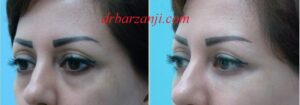 تزریق ژل بلوترو در فرورفتگی زیر چشم