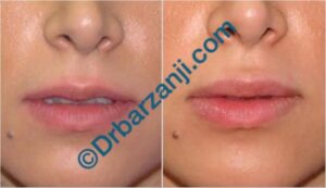 تزریق ژل جوویدرم ( ژوویدرم ) به لب