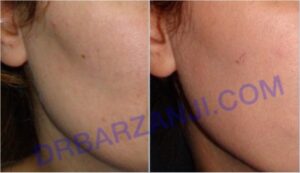 تزریق چربی در صورت