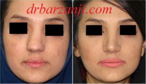 جراحی بینی کج