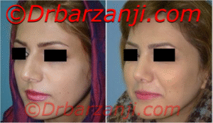 عکس قبل و بعد جراحی پلاستیک بینی شش ماه بعد