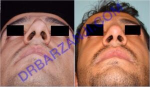 جراحی بینی، شش ماه بعد از عمل