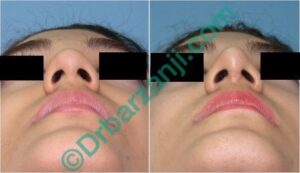 جراحی بینی ٦ ماه بعد از عمل