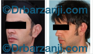 عمل جراحی پلاستیک برجستگی لاله گوش