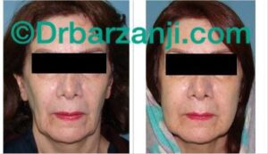 تزریق چربی صورت