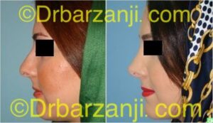 عمل جراحی زیبایی بینی یک سال بعد