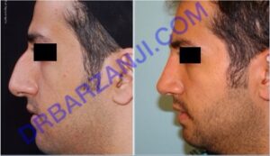 جراحی بینی، شش ماه بعد از عمل