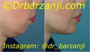 پروتز چانه و لیپوساکشن غبغب