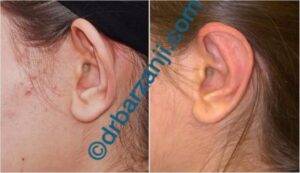 جراحی برجستگی لاله گوش