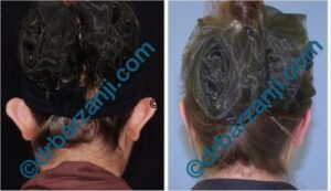 جراحی برجستگی لاله گوش