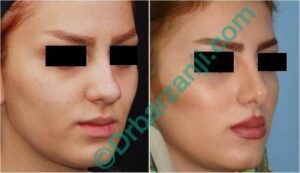 جراحی پلاستیک بینی شش ماه بعد از عمل