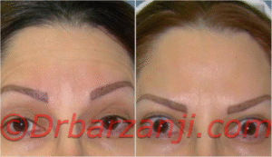 کاهش چین و چروک پیشانی با تزریق بوتاکس ( دیسپورت )