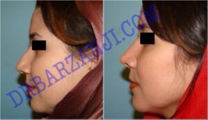 جراحی بینی ، ۶ ماه بعد از عمل