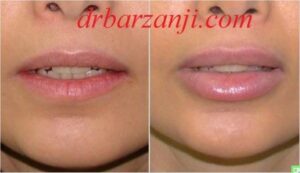 تزریق ژل جوویدرم در لب