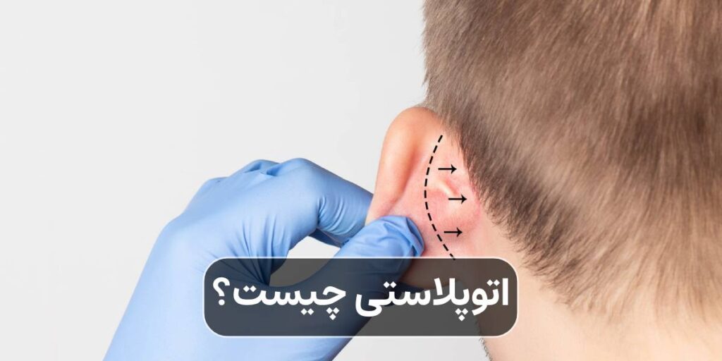 اتوپلاستی چیست