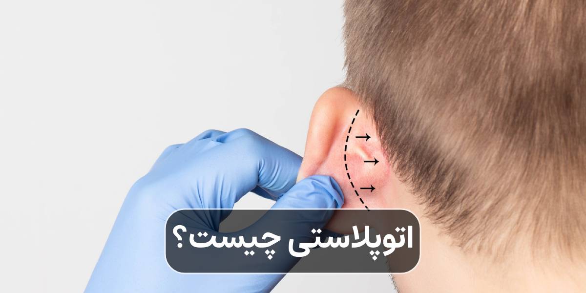 اتوپلاستی چیست