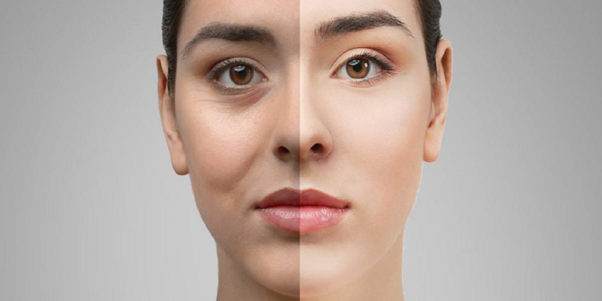 بلفاروپلاستی در تهران