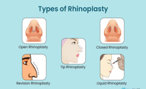انواع رینوپلاستی