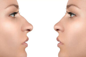 رینوپلاستی: انواع عمل بینی و مزایای هر کدام
