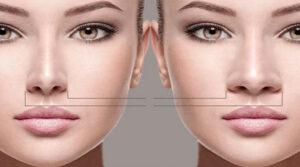 عمل بینی استخوانی و گوشتی: چه تفاوت ‌هایی وجود دارد؟